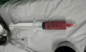 Cô gái suýt hỏng vòng một vì tiêm filler trôi nổi Cô gái suýt hỏng vòng một vì tiêm filler trôi nổi